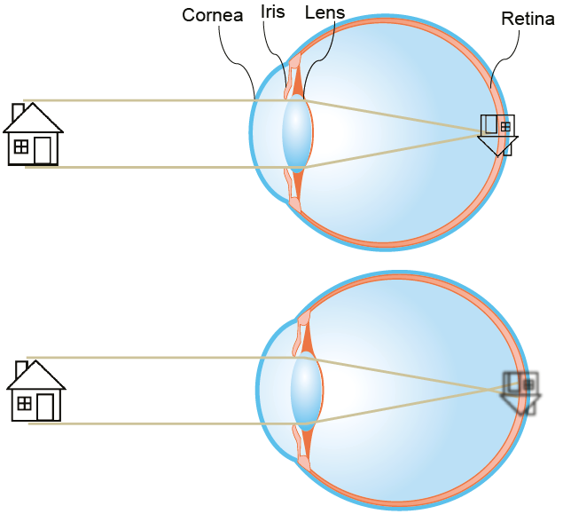 近视防控镜片为什么能控制近视？